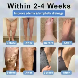 Llimpki® Black Cumin Edema Detox Herbal Cream