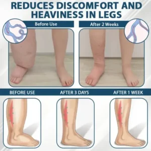 Llimpki® Black Cumin Edema Detox Herbal Cream
